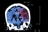 ‘Silent’ Brain Infarcts Common, Tied to Cognitive Decline in A-fib