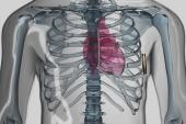 Subcutaneous ICD Holds Up Well Against Transvenous Devices