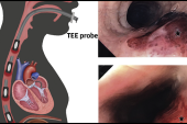 High TEE Injury Rate in Structural Heart Interventions Warrants Caution