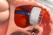 FDA Approves Next-Generation Watchman FLX Device for LAA Occlusion