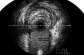 Better Outcomes, Including Mortality, With IVUS-Guided PCI: Medicare Analysis