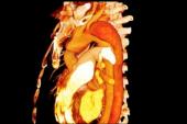 Unruptured Thoracic Aneurysm in TAVR Tied to Aortic Dissection, Cardiac Tamponade