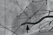 When a Pacemaker Lead Complicates Transcatheter Tricuspid Replacement: New Insights