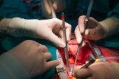 Even in Ideal Patients, Surgeons Aren’t Doing Multiarterial CABG
