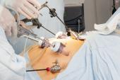 Bariatric Surgery Tied to Better Long-term Outcomes After MI 