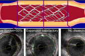 IVUS-Guided PCI Gains Support With Longer-Term ULTIMATE Results