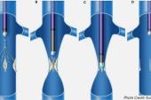 Lasers Can Aid Retrieval of Stubborn IVC Filters