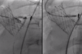 Unplanned PCI Rare After TAVI, but Operators Get Good Results