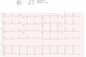 Machine Learning ‘Sniffs’ Out Long QT Otherwise Unseen on ECG 