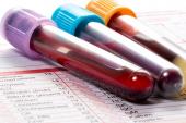 NT-proBNP Test Could Help Guide Hypertension Therapy: ARIC Analysis