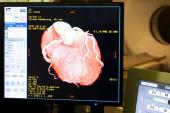 Experts Fear Coronary CT Advice for Patients Misses the Mark   