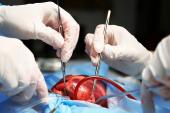 Occluding the LAA During Surgery Lowers Stroke Risk: LAAOS III
