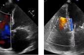 Pascal Device Works Well for Tricuspid Regurgitation in Commercial Market