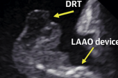 Predictors of Device-Related Thrombus Following LAA Occlusion