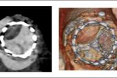 Subclinical Leaflet Thrombosis After TAVI Linked to Higher Mortality