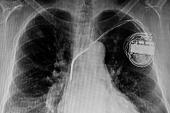Most Infected Cardiac Implanted Electronic Devices Not Removed Fast Enough