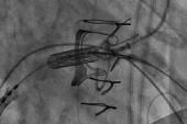  Minimalist Valve-in-Valve TMVR as Safe as Conventional Approach 