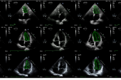 EchoNet AI Algorithm Beats Sonographers for Estimating LV Function