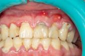 Atrial Fibrosis Mediated by Gum Disease May Be Missing AF Link