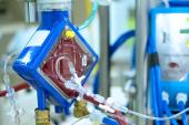 Early ECMO No Better Than Watch-and-Wait Approach in Cardiogenic Shock 