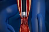 Lasers a Valuable Tool to Retrieve Embedded IVC Filters: Multicenter Study