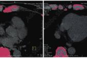 Zero CAC? LDL Cholesterol May Not Predict MI, ASCVD