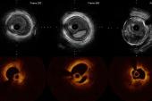 Intravascular Imaging to Inform PCI Should Be Routine: ACC Interventional Council 