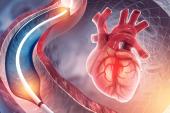 Long-term Data Support Paclitaxel-Coated Balloons for In-Stent Restenosis