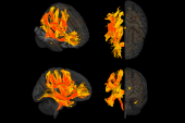 Brain Areas Identified Linking High BP and Cognitive Impairment