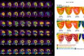 PET-Guided Strategy Lowers Risk, Boosts Outcomes in Stable CAD: CENTURY