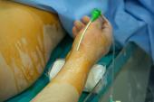 Radial Access Is Safe, Effective for Peripheral Interventions: R2P Registry