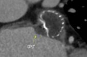 Outcomes Suffer When Device-Related Thrombus Persists or Recurs After LAAO