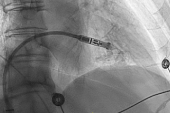 Micra Leadless Pacemaker Performs Well Through 5 Years