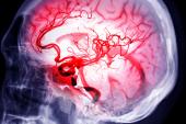 RAISE: Reteplase May Be Another Option for Stroke Thrombolysis
