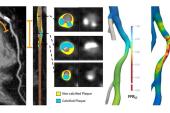 AI Assessment of Plaque, Hemodynamics May ID Lesion-Specific ACS Risk