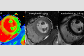 CMR Could Change Diagnosis, Management of Suspected NSTEMI: OxAMI