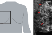 AI-Measured Breast Artery Calcification Tied to CV Outcomes in Women