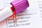 High-Sensitivity Troponin Assays Not All the Same, APACE Data Confirm