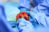 Donor Hearts Fare Better With Novel Method After Circulatory Death 