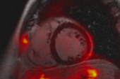 What’s the Damage With Long COVID Advanced Imaging Reveals Clues