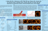 Healing Responses After Bifurcation Stenting with the Dedicated TRYTON Side-Branch Stent in Combination with XIENCE V Stents: an Angiography and Optical Coherence Tomography Study.