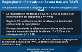 La TC en 3-D del Anillo Aórtico Predice la Regurgitación Paravalvular Severa tras una TAVR