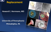 Transcatheter Mitral Valve Replacement: Rationale, Hurdles, and Contenders