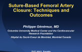 Suture-Based Femoral Artery Closure: Techniques and Outcomes