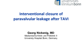 Undersized TAVR with Paravalvular Regurgitation