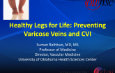 Healthy Legs for Life: Preventing Varicose Veins and CVI