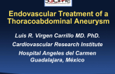 Endovascular Treatment of a Thoracoabdominal Aneurysm