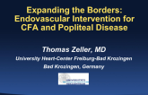 Expanding the Borders: Endovascular Intervention for Common Femoral and Popliteal Disease
