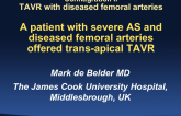 Case Presentation Introduction: Patient with Severe AS and Diseased Femoral Arteries Offered Transapical TAVR