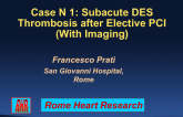 Case 1: Subacute DES Thrombosis After Elective PCI (with Imaging)